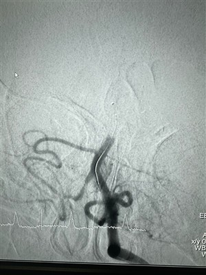 Uusi kotelo dredgerstentinnoutajalle